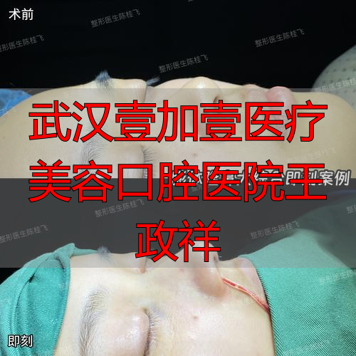 2026年避坑指南！深度评价武汉王政祥医生：隆鼻眼综合究竟哪个好？