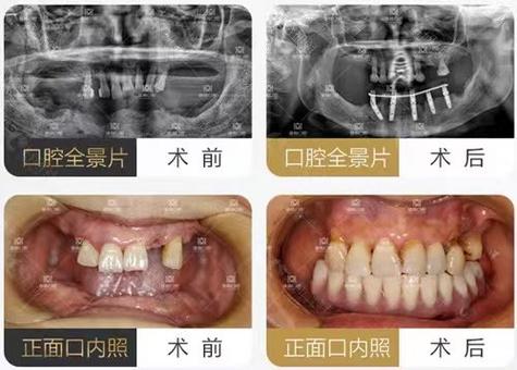 干燥症取口腔腺体样_口腔种植门诊病历样本_泽美口腔门诊部种植牙怎么样