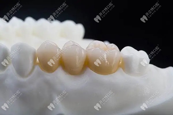 海口爱牙口腔镶牙冠多少钱一颗