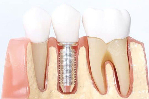 单颗种植牙模型图