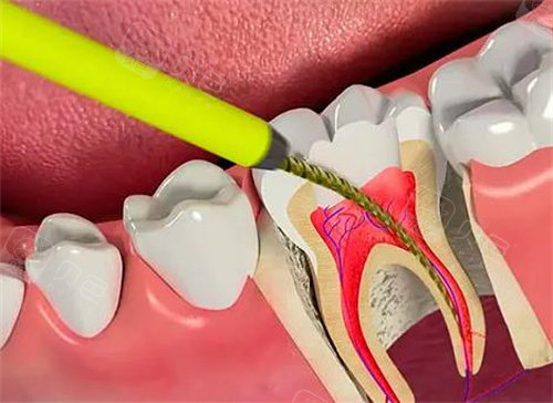 根管治疗示意图