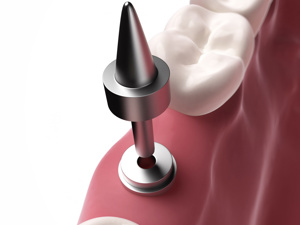 本地聚焦:南京想种植牙哪家好又便宜(南京)种植牙多少钱一颗2026价格表南京-牙拔掉以后不种牙会怎么样